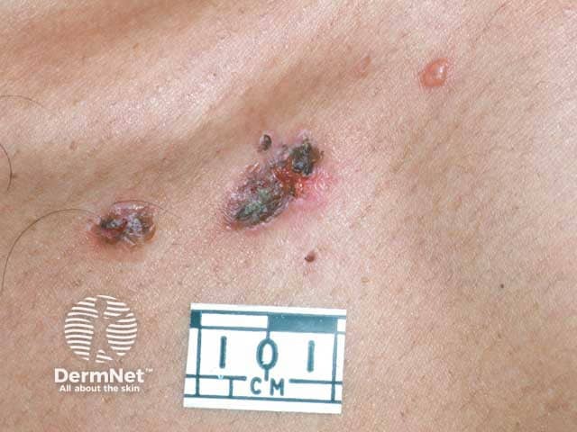 Интактный пузырь и эрозии при вульгарной пузырчатке