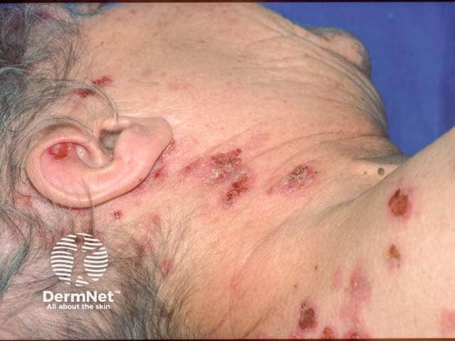Эрозии на шее и верхней части спины при вульгарной пузырчатке