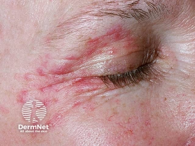 Периокулярный дерматит: эритематозные папулы и шелушение в периорбитальной области