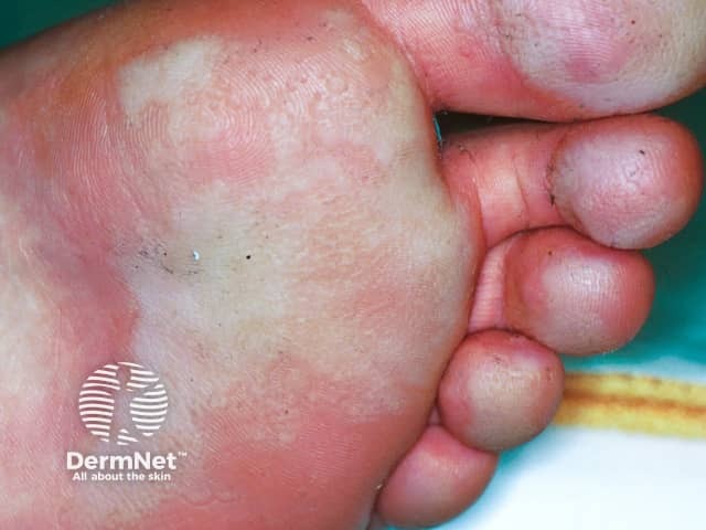 Белесая мацерированная кожа стоп с точечными кратерами при мелкоточечном кератолизе