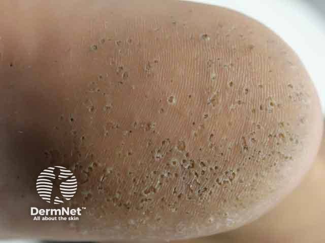 Точечные дефекты на пятке при мелкоточечном кератолизе
