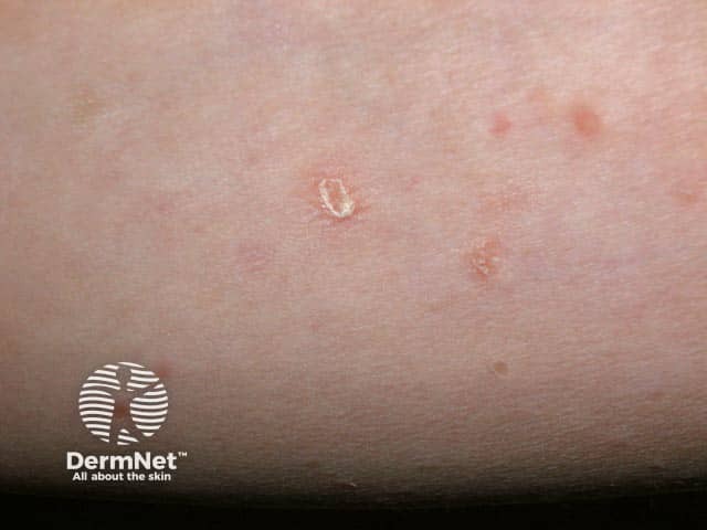 Слюдоподобная чешуйка при хроническом лихеноидном парапсориазе
