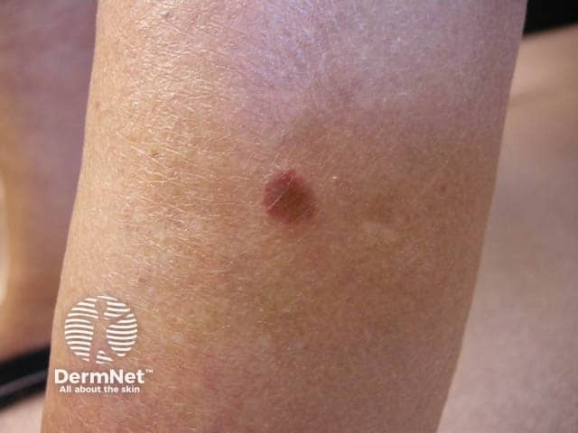 Свежий элемент сыпи при остром лихеноидном парапсориазе на ноге крупным планом