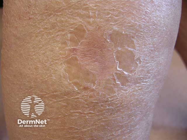 Шелушение на этапе разрешения очага острого лихеноидного парапсориаза