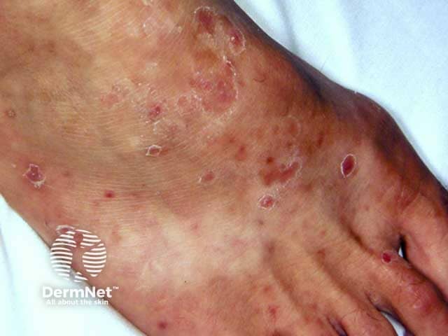 Острый лихеноидный парапсориаз с поражением стопы