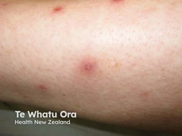 Крупный план: хронический лихеноидный парапсориаз с наслоением чешуек на эритематозных папулах