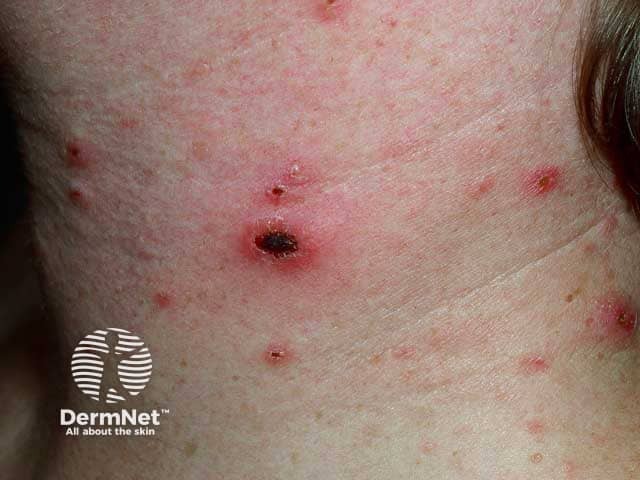 Изъязвленные папулы при остром лихеноидном парапсориазе