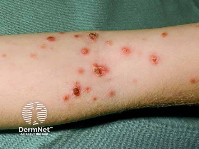 Язвенно-некротические очаги острого лихеноидного парапсориаза на руке