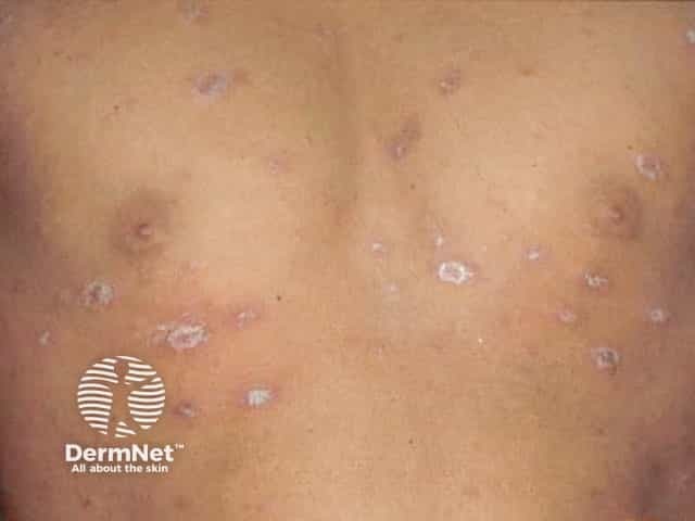 Кольцевидные шелушащиеся пятна при розовом лишае на темной коже