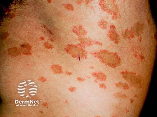 Кольцевидные элементы с шелушащимся воротничком при розовом лишае на коже туловища