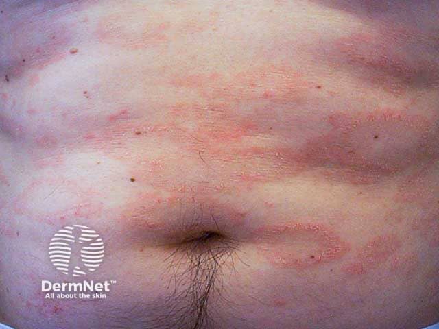 Кольцевидные шелушащиеся пятна при розовом лишае
