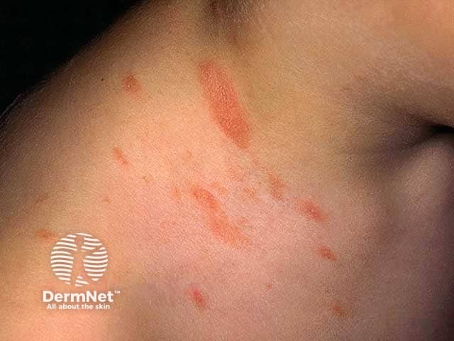 Розовый лишай на шее