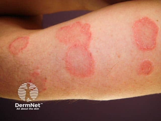 Кольцевидные шелушащиеся очаги на руке при розовом лишае