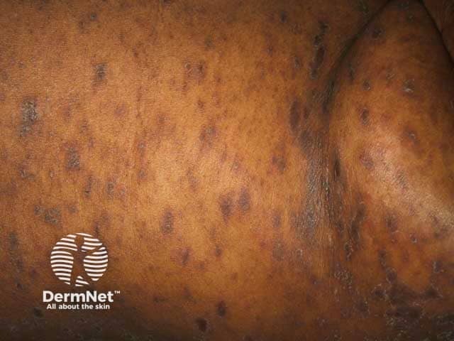 Гиперпигментированные очаги розового лишая на темной коже