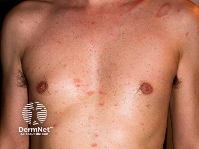 Розовый лишай и материнская бляшка в области левого плеча