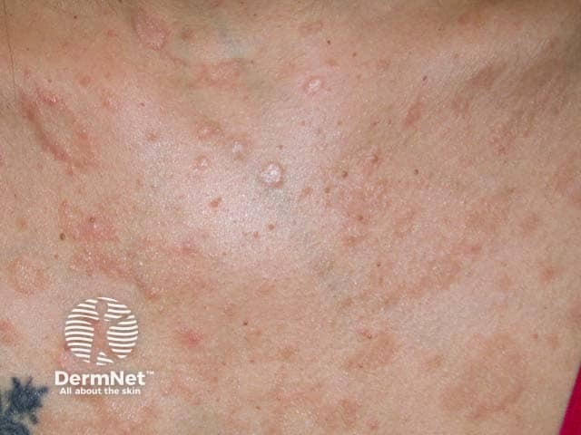 Розовый лишай на верхней части грудной клетки
