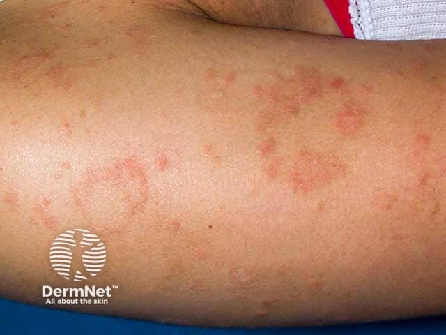 Розовый лишай и материнская бляшка на темной коже