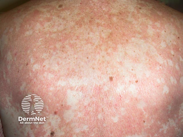 Сливная шелушащаяся эритема с островками интактной кожи при болезни Девержи 1-го типа