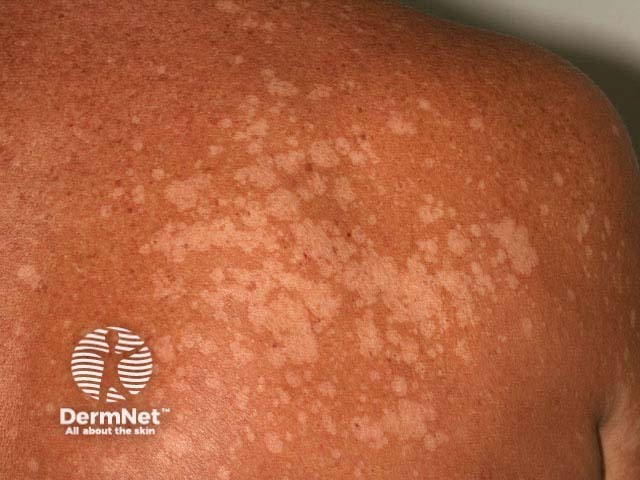 Отрубевидный лишай