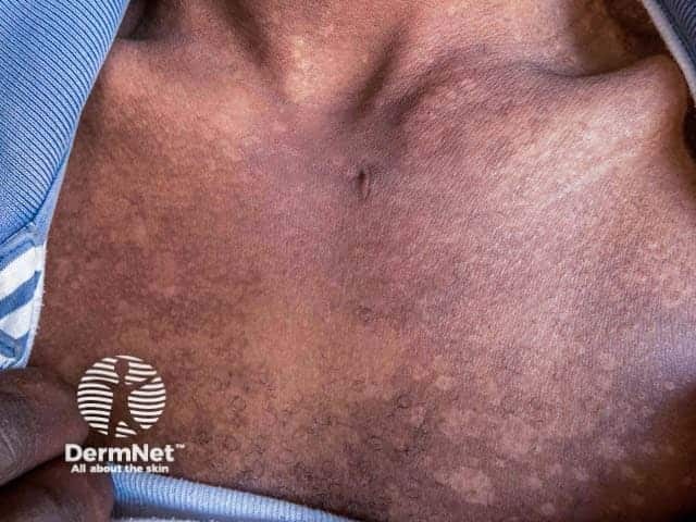 Отрубевидный лишай в гипопигментированной стадии