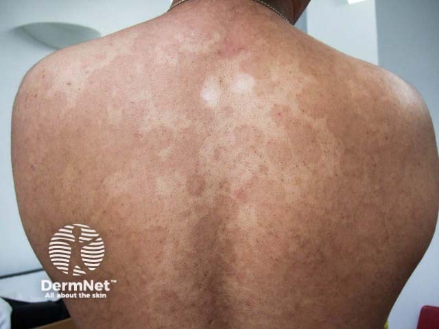 Гипопигментация вследствие отрубевидного лишая