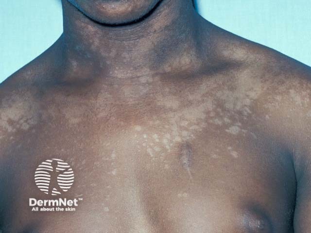 Очаги депигментации на коже верхней части туловища при отрубевидном лишае