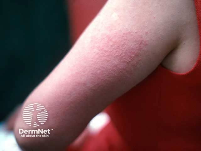Папуло-везикулезная форма полиморфного фотодерматоза на коже руки