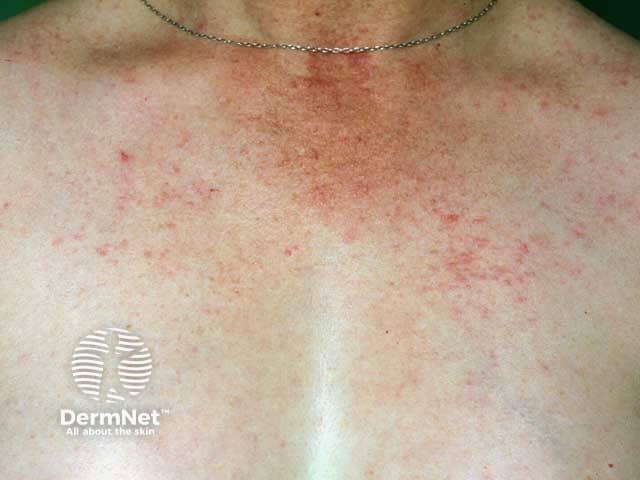 Папулезная форма полиморфного фотодерматоза на верхней части груди