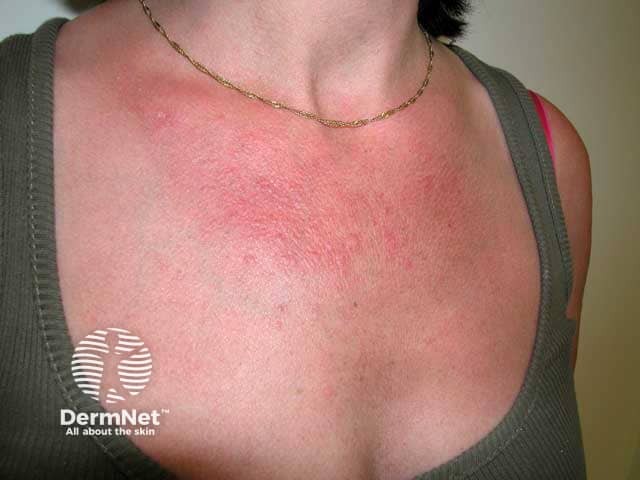 Сливающиеся папулезные высыпания при полиморфном фотодерматозе на груди