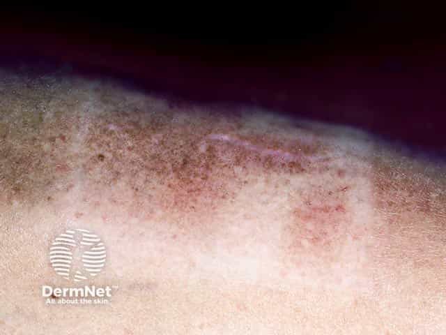 Снимок крупным планом: отек голени, обусловленный претибиальной микседемой