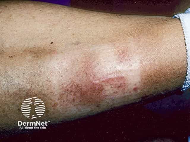 Претибиальная микседема непосредственно над лодыжкой у пациента с тиреотоксикозом в анамнезе