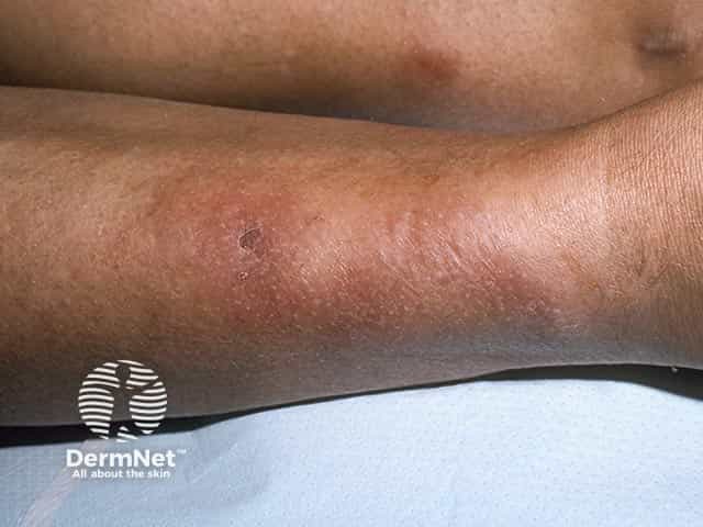 Диффузный мягкий отек в претибиальной области при претибиальной микседеме