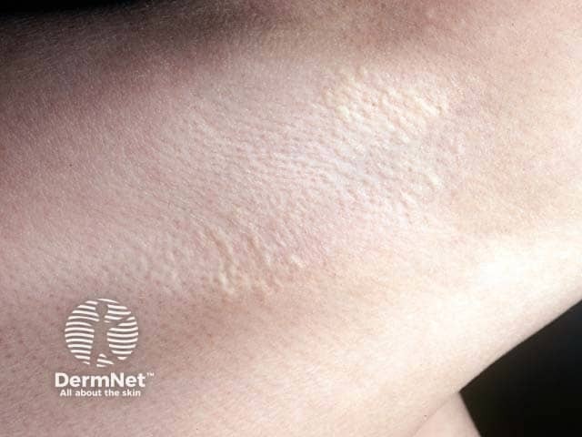 Линейно расположенные кремово-желтые папулы при эластической псевдоксантоме в подмышечной впадине