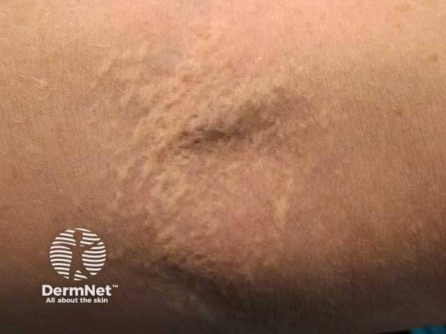 Линейные и сетчатые желтоватые бляшки в области локтевого сгиба при эластической псевдоксантоме