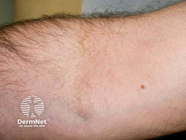 Проявления эластической псевдоксантомы в локтевой ямке у пациента с ассоциированной слепотой