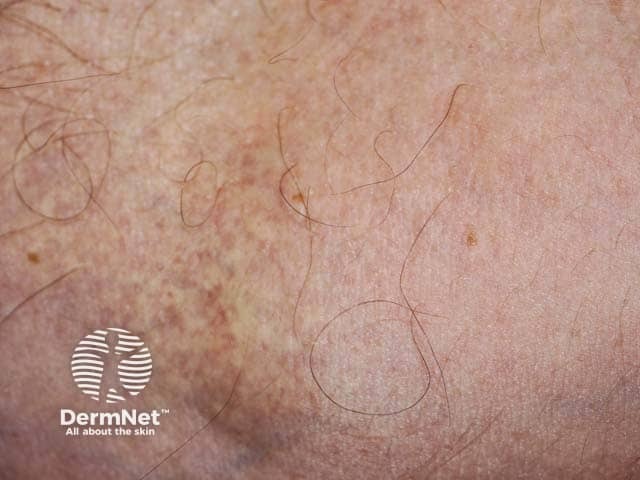 Проявления эластической псевдоксантомы в локтевой ямке у пациента с ассоциированной слепотой