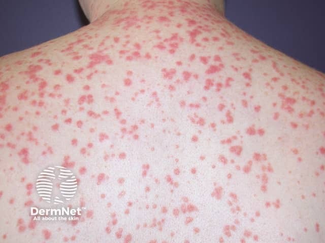 Мелкие псориатические бляшки, напоминающие брызги дождевых капель на коже