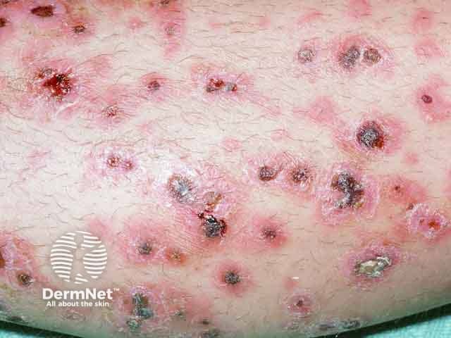 Язвы, эрозии и корки на нижних конечностях при гангренозной пиодермии