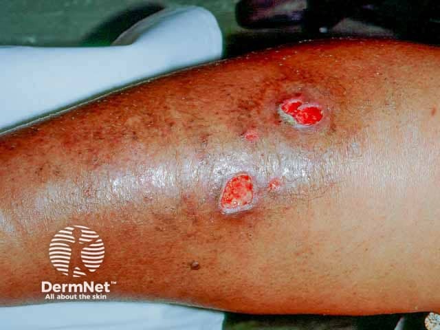 Хронические вялотекущие язвы голени при гангренозной пиодермии