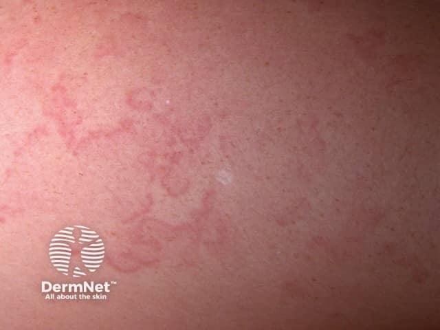 Кольцевидная эритема (erythema marginatum)