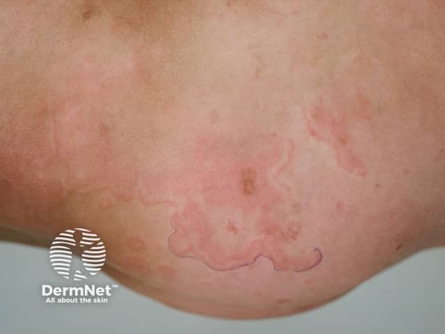 Кольцевидная эритема (erythema marginatum)