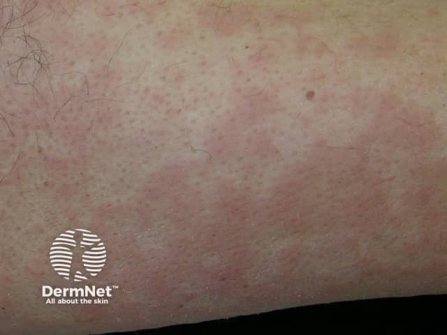 Кольцевидная эритема (erythema marginatum)