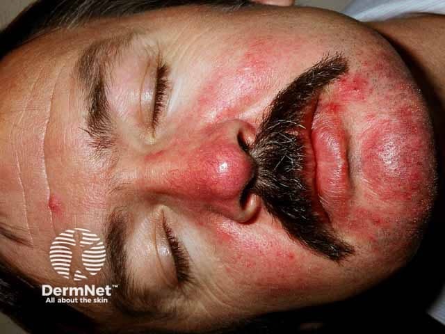 Эритематозно-телеангиэктатическая розацеа в области носа, щек и подбородка