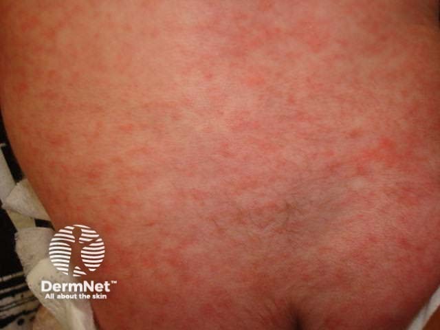 Характерные бледнеющие эритематозные пятна и папулы при детской розеоле