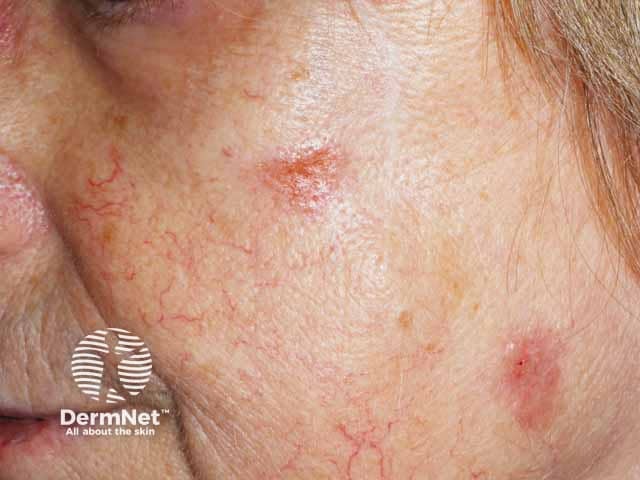 Бляшки саркоидоза на коже щек, симулирующие базальноклеточный рак