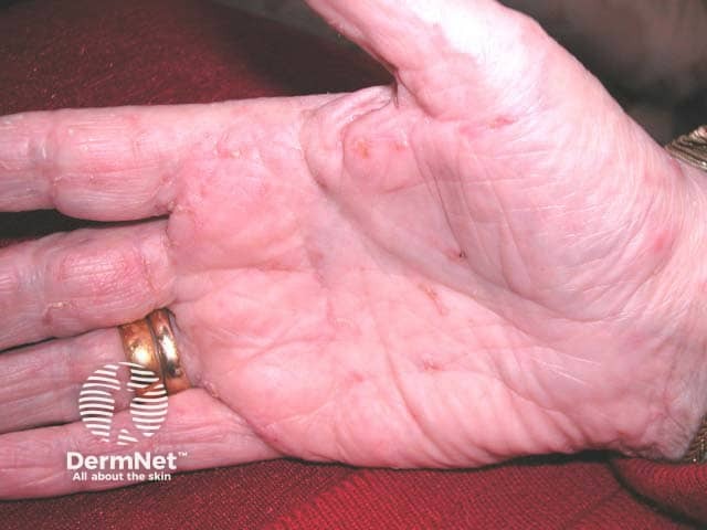 Множественные чесоточные ходы на ладони у пожилой женщины