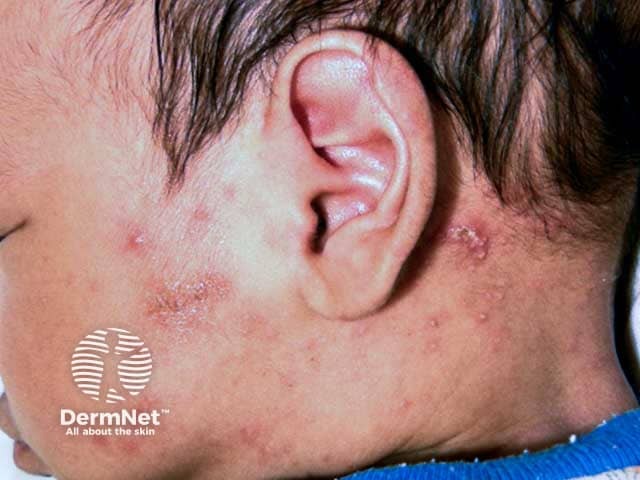 Поражение кожи лица и шеи при чесотке у младенца