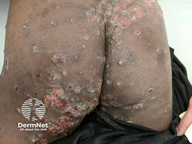 Скабиозные узелки (часть с изъязвлением) на ягодицах со вторичной бактериальной инфекцией