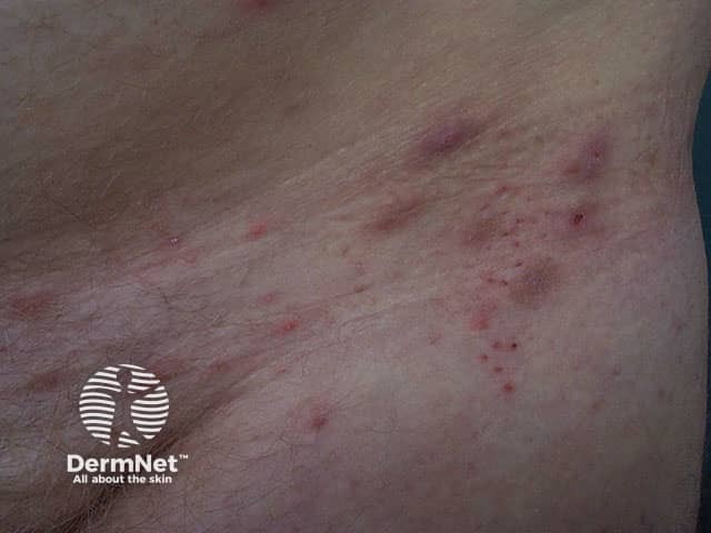 Длительно текущая (хроническая) чесотка
