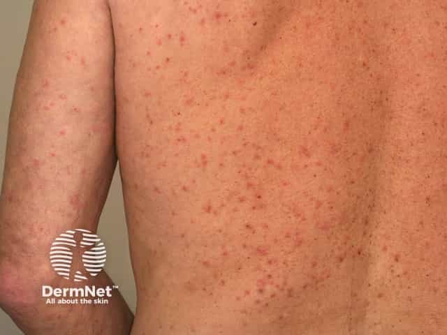Аллергическая сыпь гиперчувствительности при чесотке